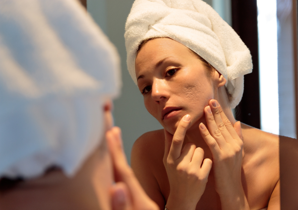 Woman examining one of the types of acne scars on her cheek.