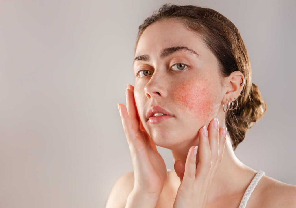 What’s Triggering Your Rosacea?